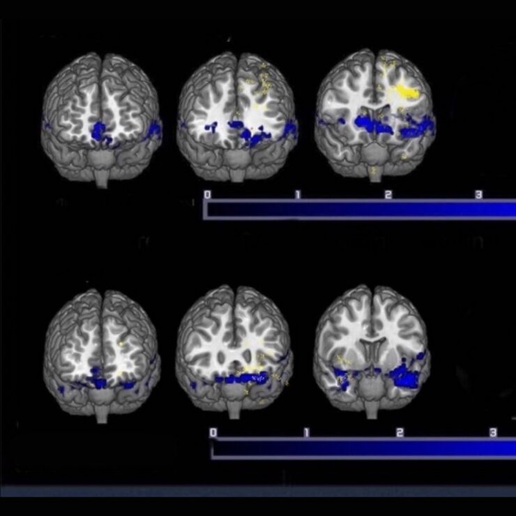 TMS blog brain scan.jpg